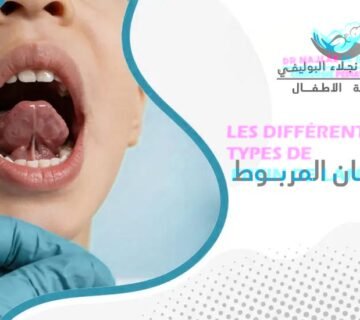 أنواع اللسان المربوط عند الأطفال وأعراضه وعلاجه