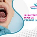 Les différents types de frein de langue chez l’enfant