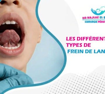 Les différents types de frein de langue chez l’enfant