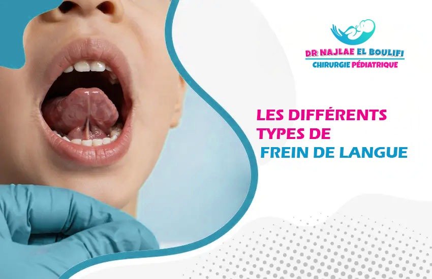 Les différents types de frein de langue chez l’enfant